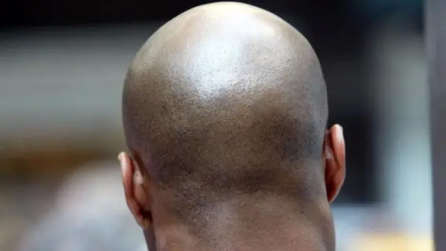 The head of a bald man seen from behind