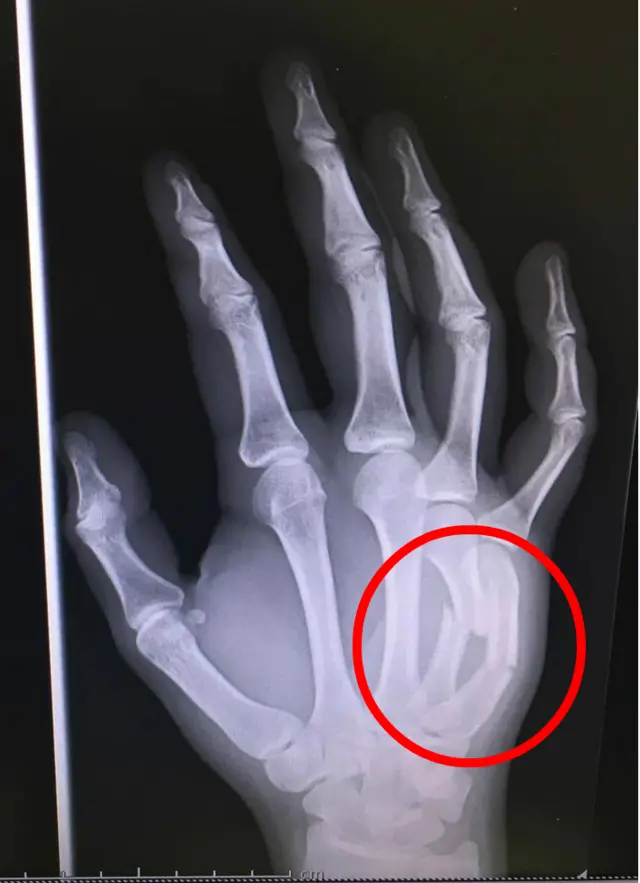 Broken hand