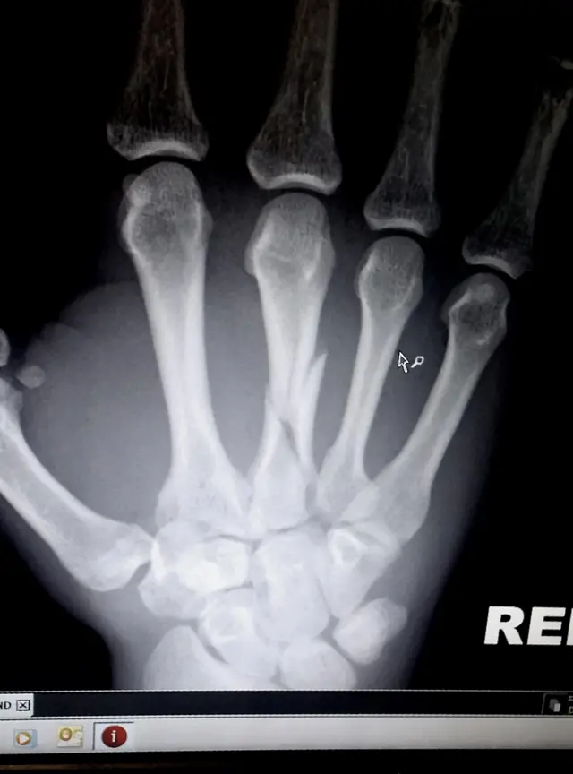 X-ray of hand