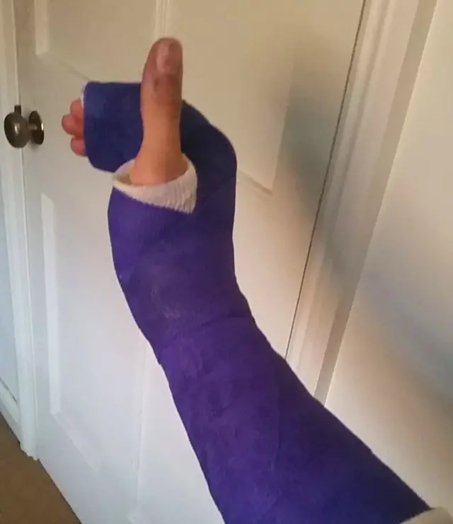 Hand in a cast