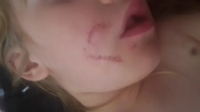 Girl bitten by dog