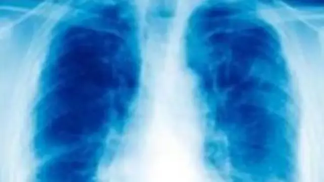 Lung x-ray