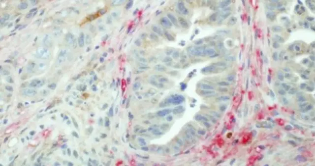 Pancreatic cancer tissue