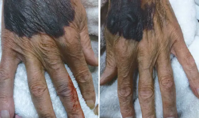 Victim's hands after burglary