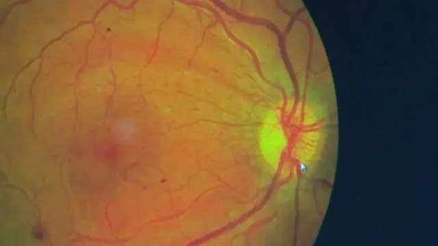 Retinopathy looks like this when screened