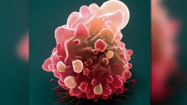 Bowel cancer cell