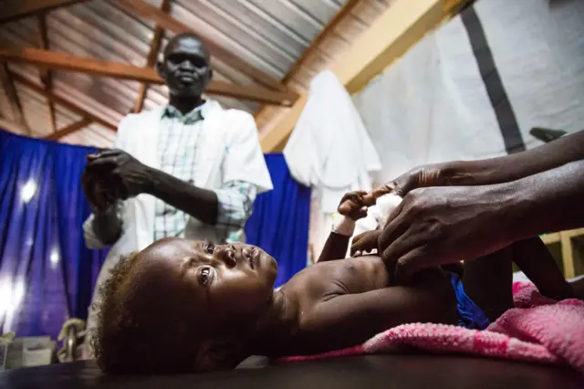 A malnourished child in South Sudan