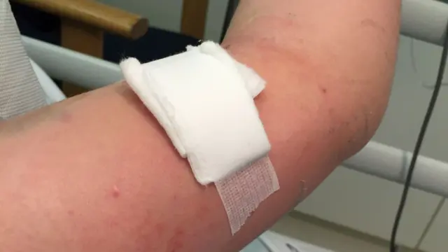 Katie Dutton arm with sepsis