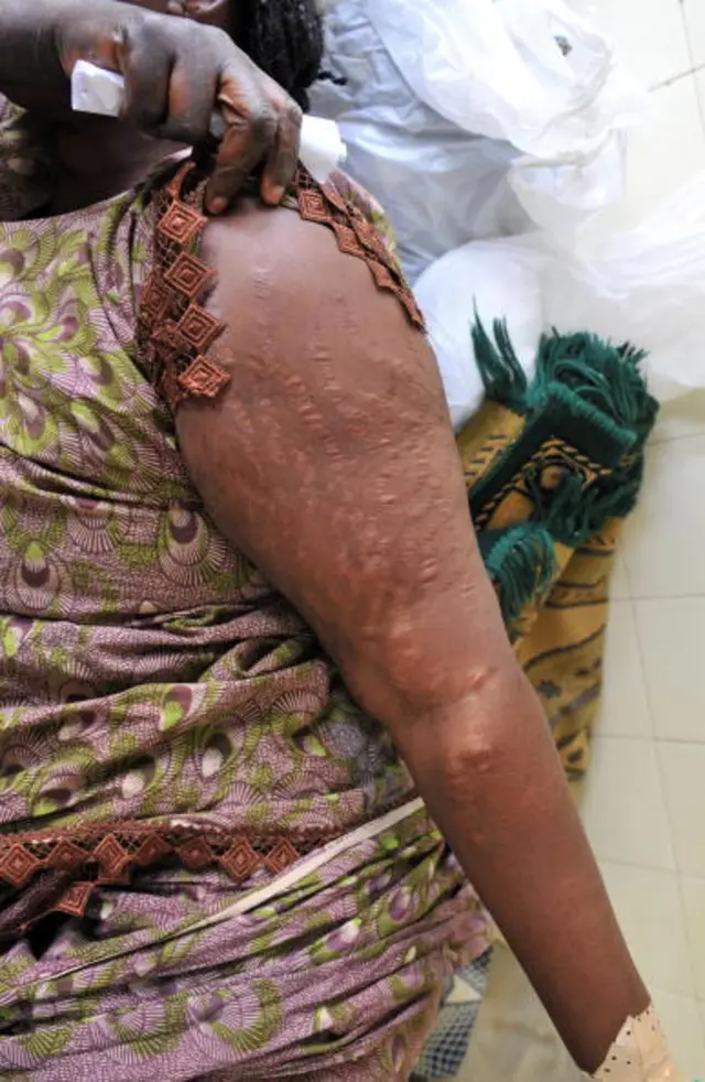 A woman shows scars on her arm at a hospital in Dakar caused by using skin lightening creams on May 20, 2009.