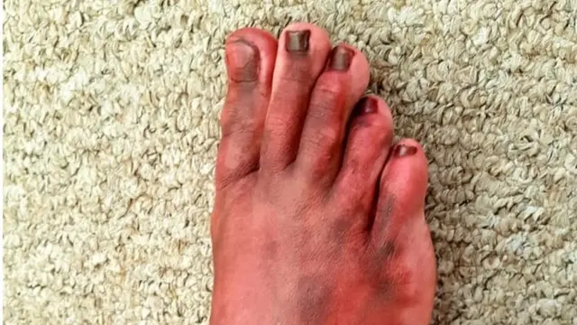 bruised foot