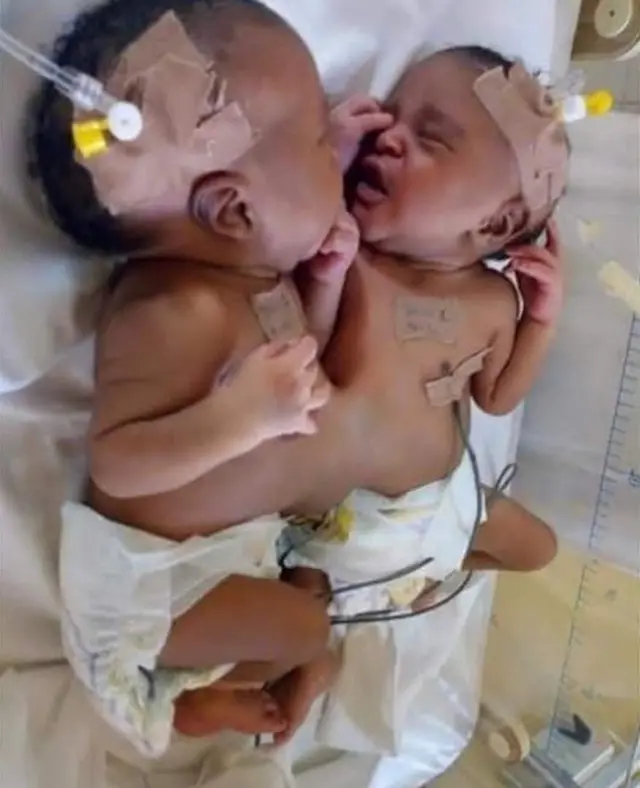 Conjoined twins separated