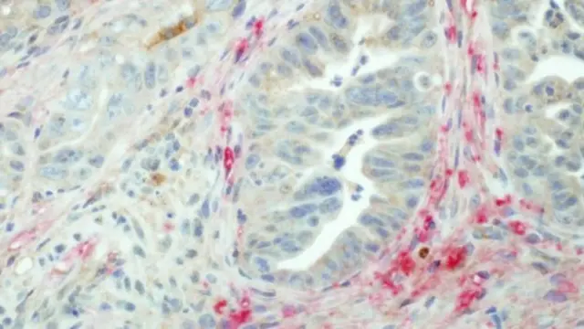 Pancreatic cancer tissue