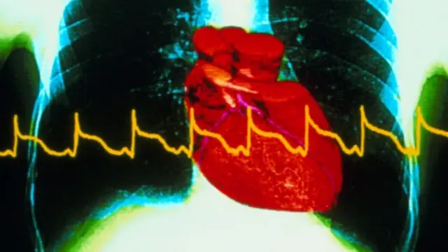 ECG trace in heart attack