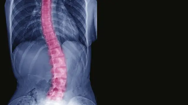 Curved spine in scoliosis