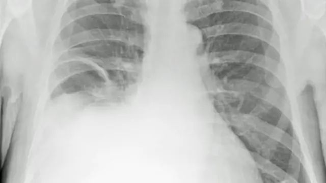 Chest x-ray