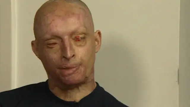 Acid attack victim Daniel Rotariu