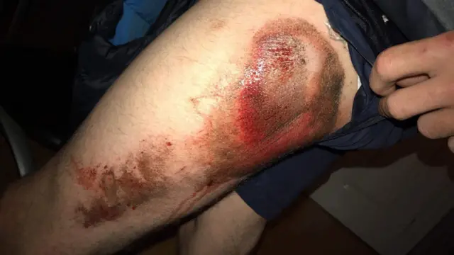 Skin grazes on a boy's leg