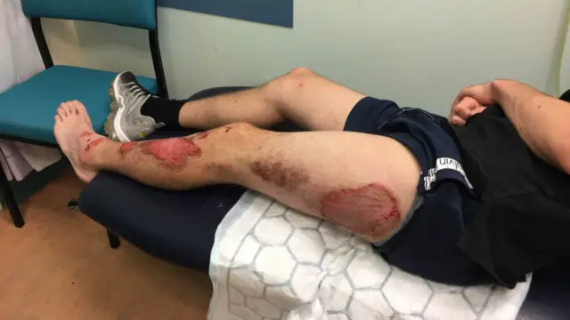 Skin grazes on a boy's leg