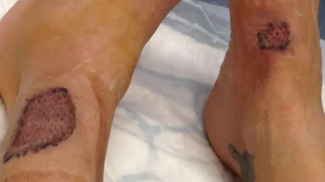 Burn on leg and foot