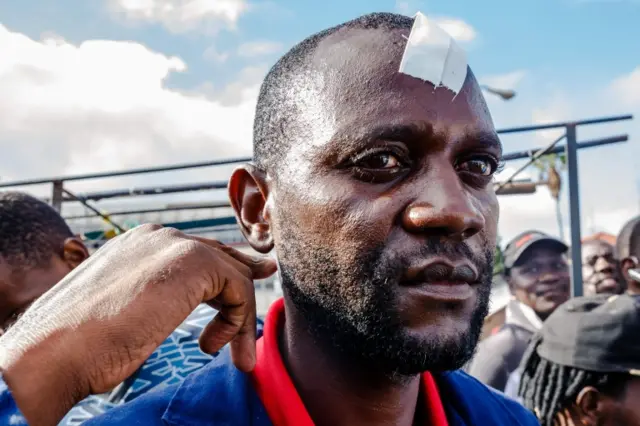 Justice Chiutsi points to a wound on his neck and another on his forehead outside Harare Central Police Station on February 23, 2018, in Harare. Chiutsi, a cellphone vendor was shot by a policeman during clashes between commuters and police blocking commuter buses from enter ng the central business district of Harare.