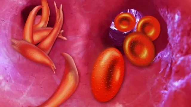 An illustration of sickle cells