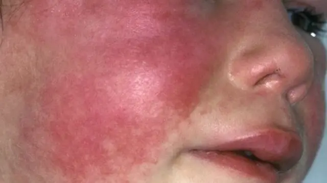 Scarlet fever on the face