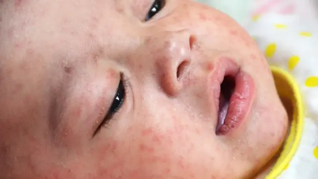 Baby with measles