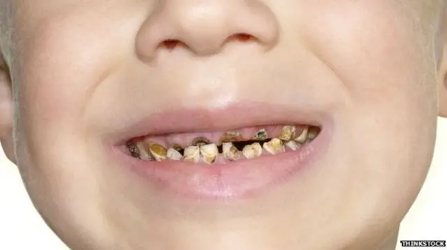 Child's teeth, library photo