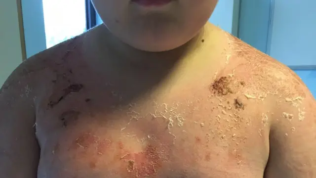 Jake Andrews sunburn