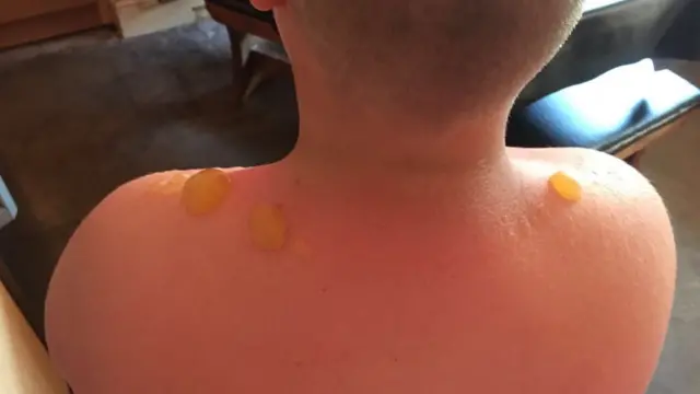 Jake Andrews sunburn