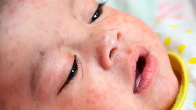 A child with measles.