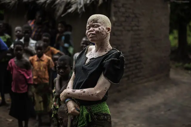 Mainasi Issa, a 23-year-old Malawian albino woman, stands outside her home in the traditional authority area of Nkole, Machinga district, on April 17, 2015.