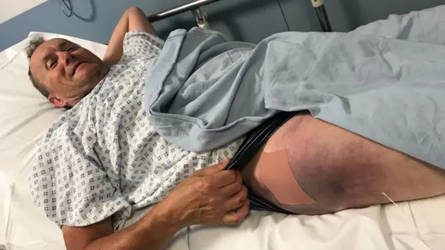 Man lies in hospital with bruised leg