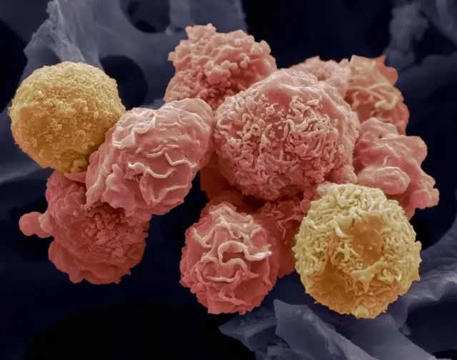 Cervical cancer cells.