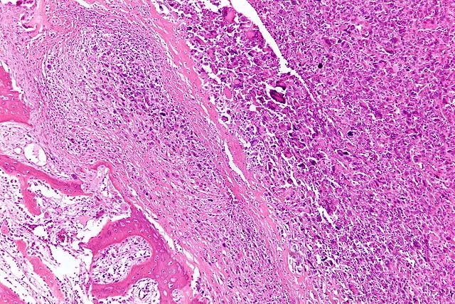 Intermediate magnification micrograph of a high-grade osteosarcoma