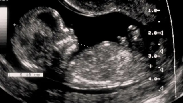 Baby scan