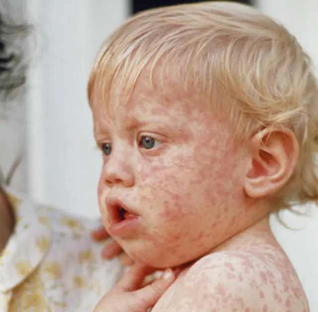 baby with measles