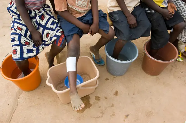 People soak their feet in Ghana as part of treatment for Guinea