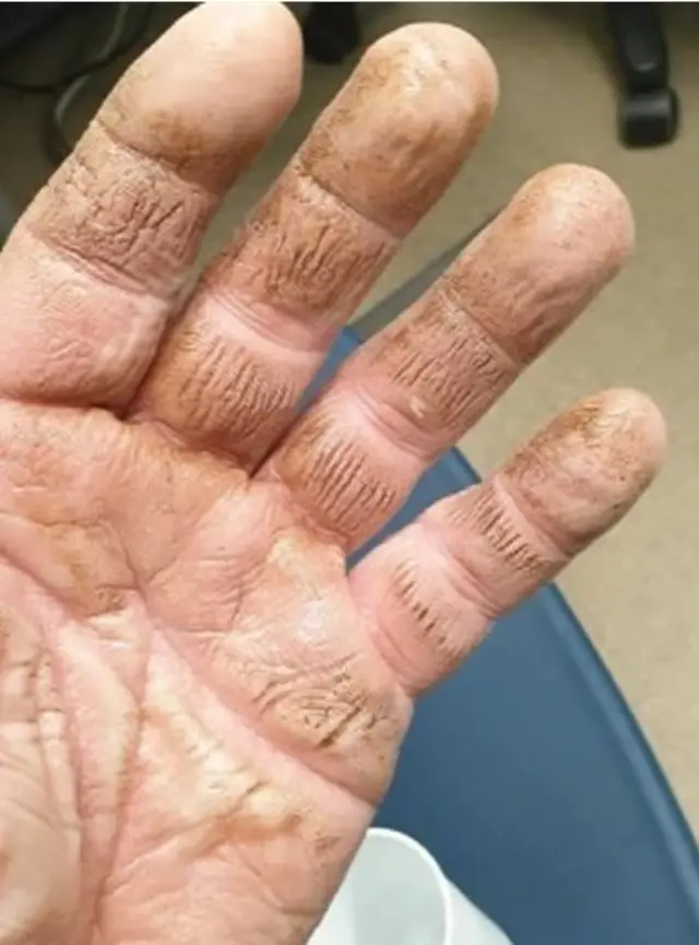 Burnt hand