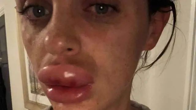 Rachael Knappier's swollen lips