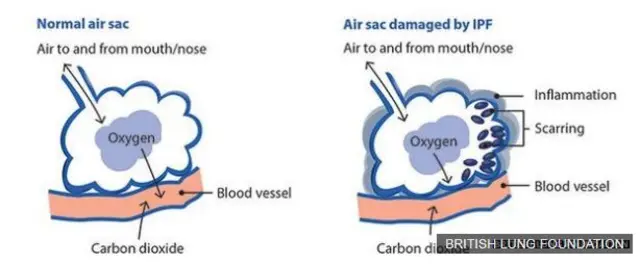 Comparison between normal air sac in the lung and one damaged by IPF