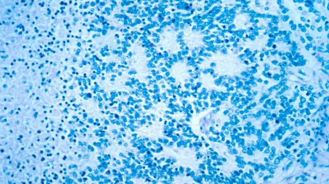 A microscopic view of a typical neuroblastoma