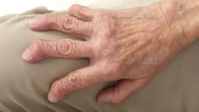 Arthritic hand