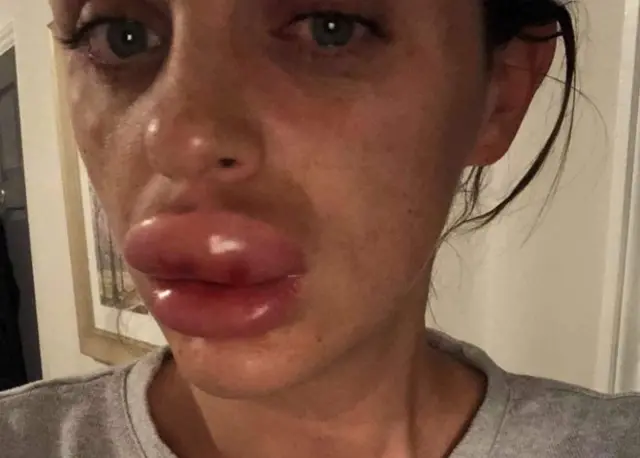 Rachael Knappier did not leave her house for more than a week after her lips swelled dramatically as a result of lip filler being "incorrectly administered"