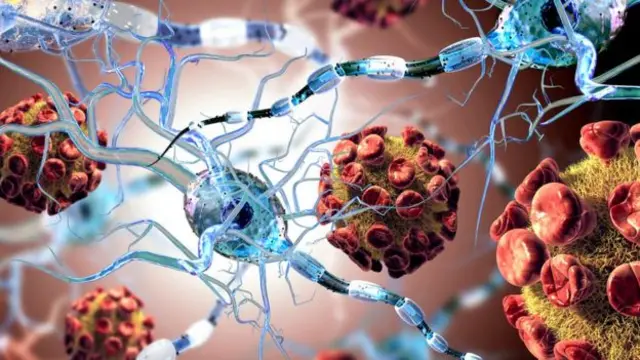 Nerve connections become damaged in people with MS