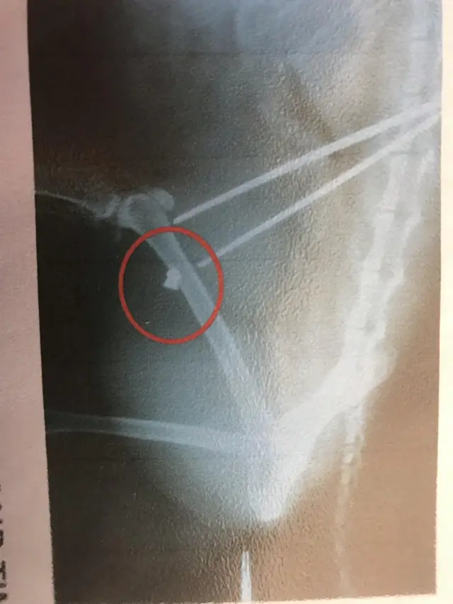 An X-ray of Nev's injury