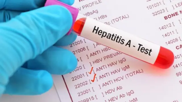 Hepatitis A test