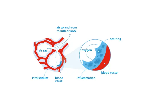 Diagram of IPF