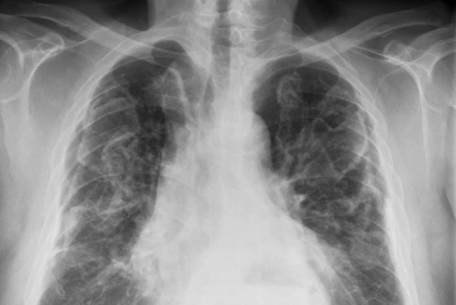 Lung x-ray