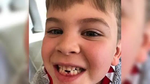 Ryan smiling after losing a tooth